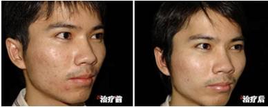 PDT Home Use Led Skin Rejuvenation