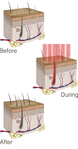 Diode lipo laser machine for hair loss treatment, hair regrowth