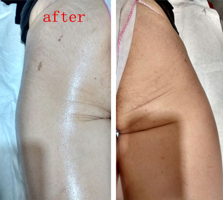 SMAS Contraction Liposonix 13mm HIFU Machine Reducing Sagging Of Skin